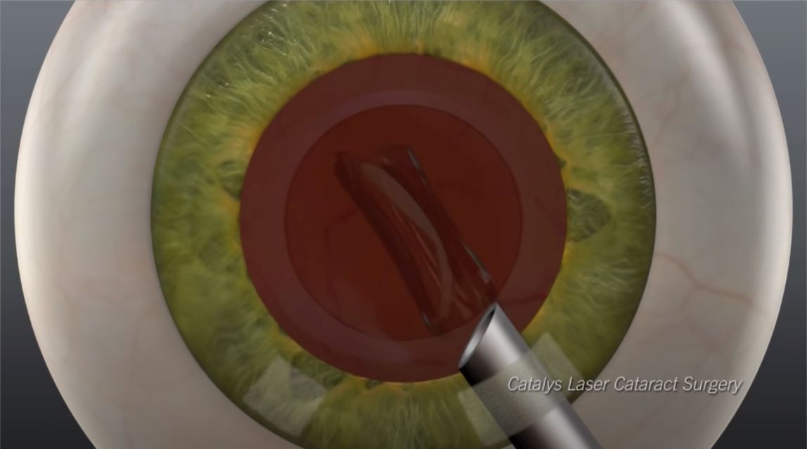 MANUAL CATARACT SURGERY VS LASER CATARACT SURGERY